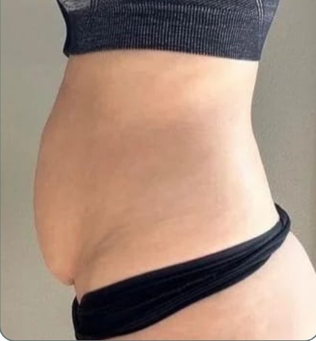 Side view of a client's tummy before treatment