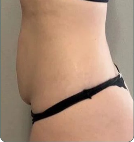 Side view of the same client's tummy after a course of treatment