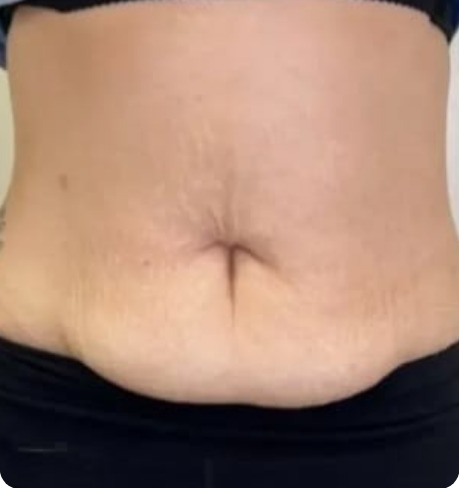Front view of the same client's tummy after a course of treatment