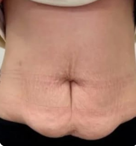 Front view of a client's tummy before treatment